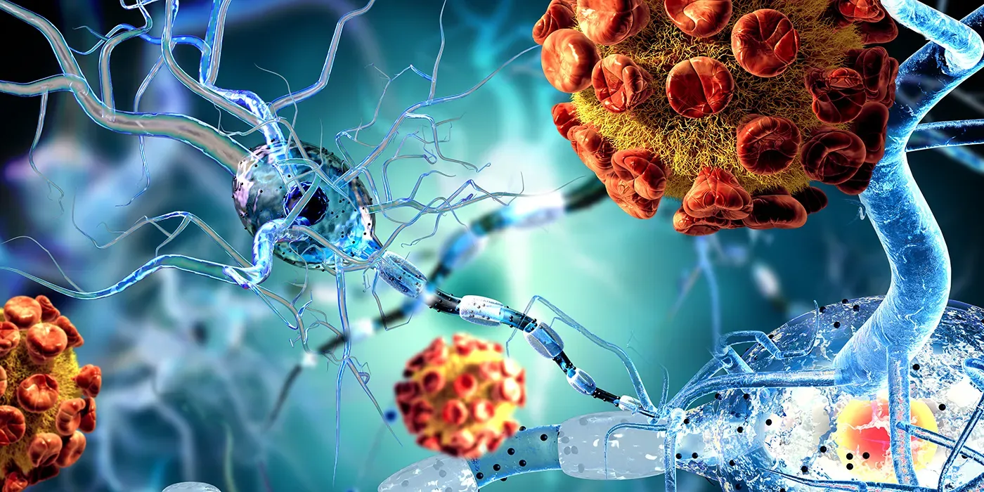 5 Ways Immune Attack on Smell Pathways Signals Early Alzheimer’s 1 Immune Attack on Smell Pathways Signals Early Alzheimer’s