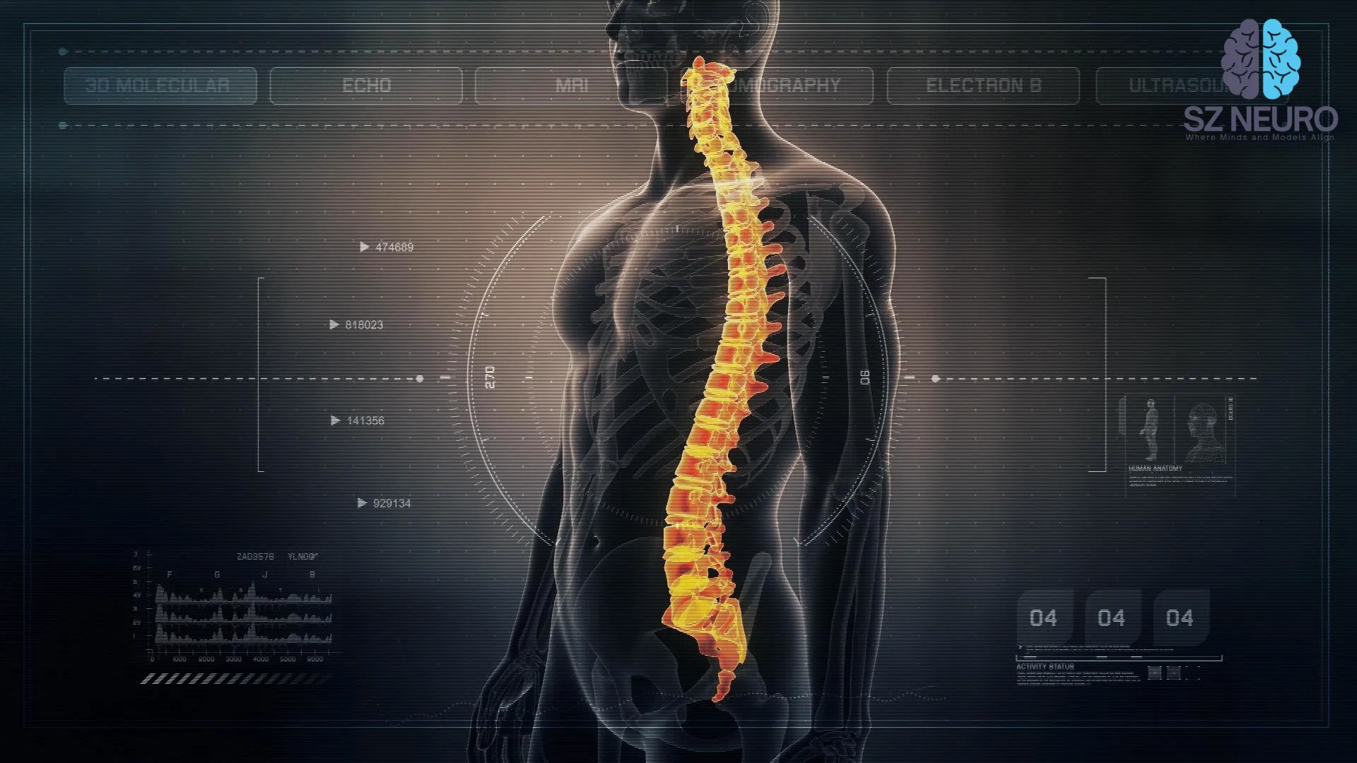 Spine Implant Surgery Restores Movement
